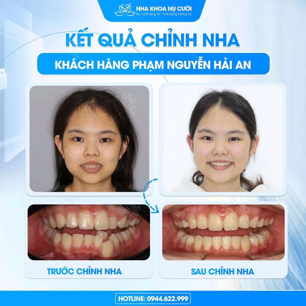 thay-doi-khuon-mat-sau-nieng-rang