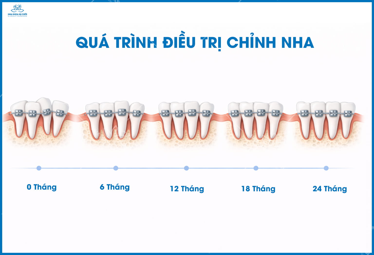 Niềng Răng Mất Bao Lâu? Thời Gian Chỉnh Nha Trung Bình