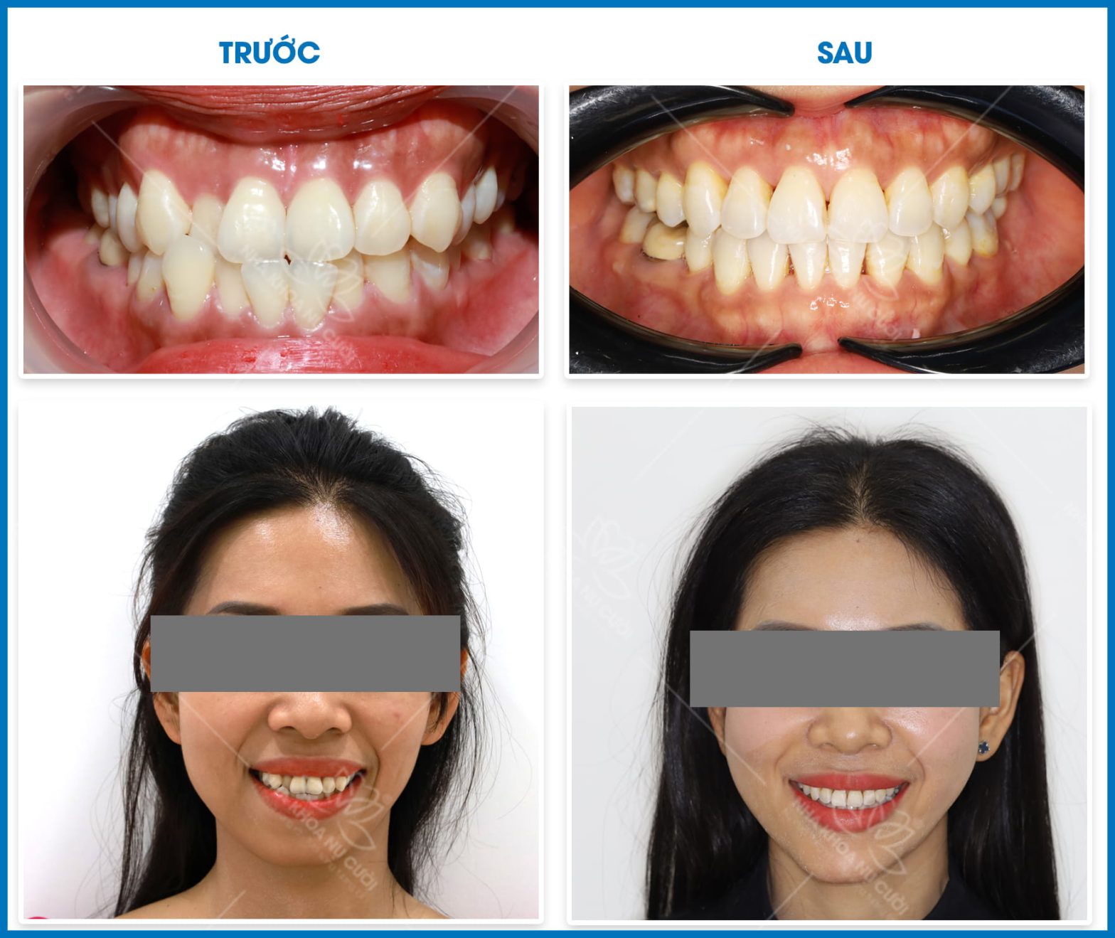 Niềng răng người lớn có hiệu quả không? Sau 30 tuổi có muộn?