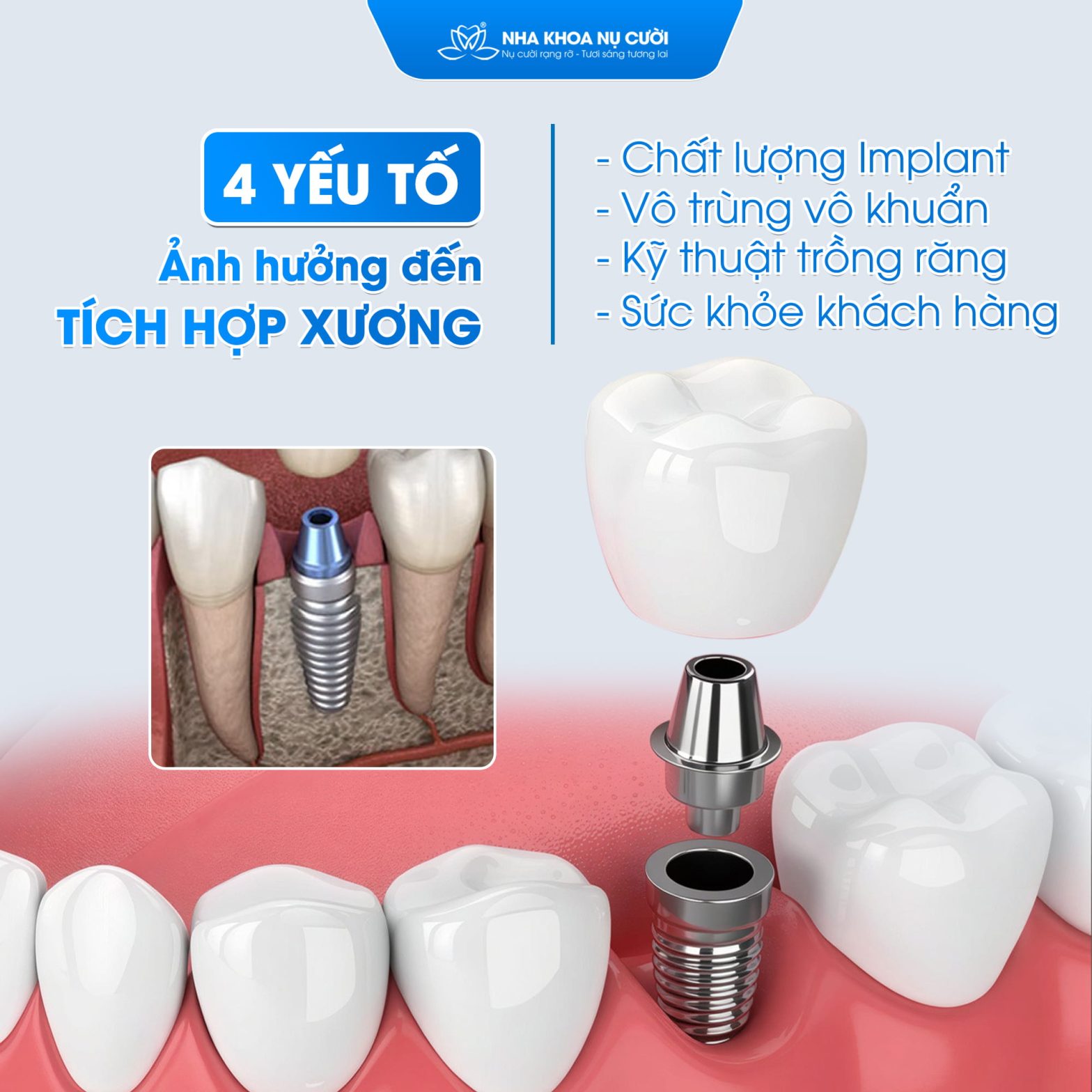4 Yếu Tố Quyết Định Tích Hợp Xương Implant