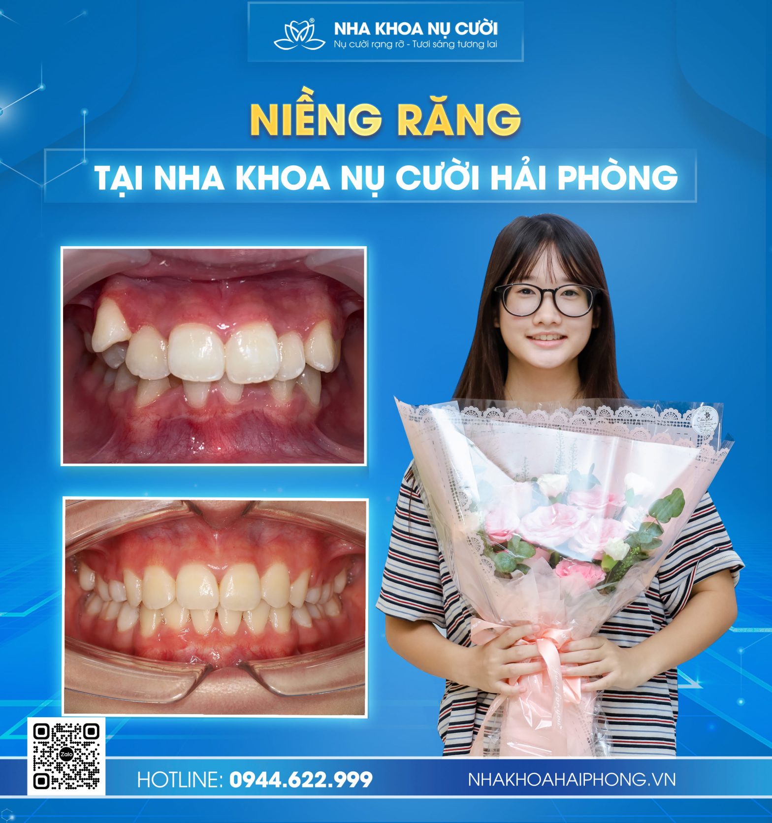 NIỀNG RĂNG – CHỈNH NHA TẠI HẢI PHÒNG