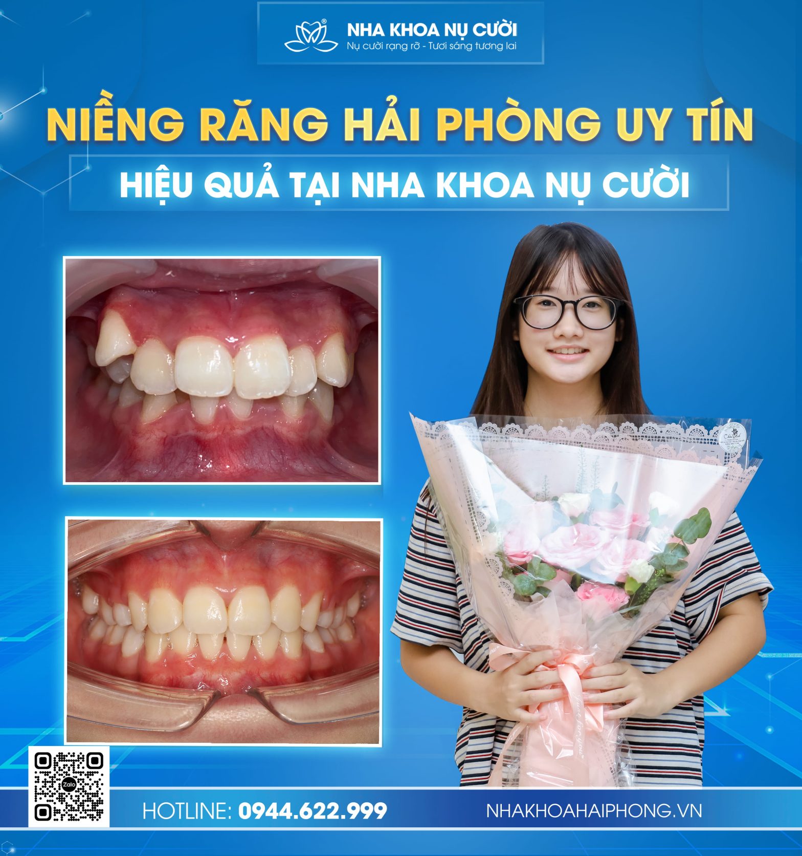 NIỀNG RĂNG HẢI PHÒNG UY TÍN – HIỆU QUẢ TẠI NHA KHOA NỤ CƯỜI