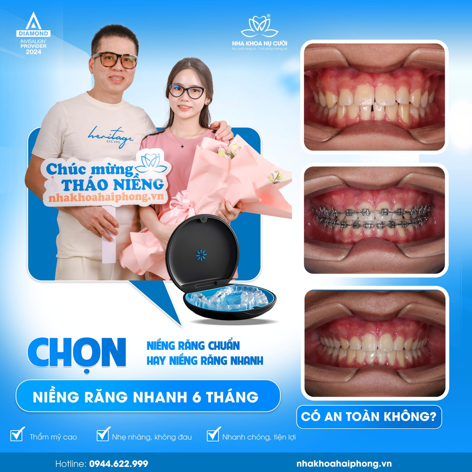 Niềng răng nhanh 6 tháng có an toàn không? Sự thật bạn cần biết