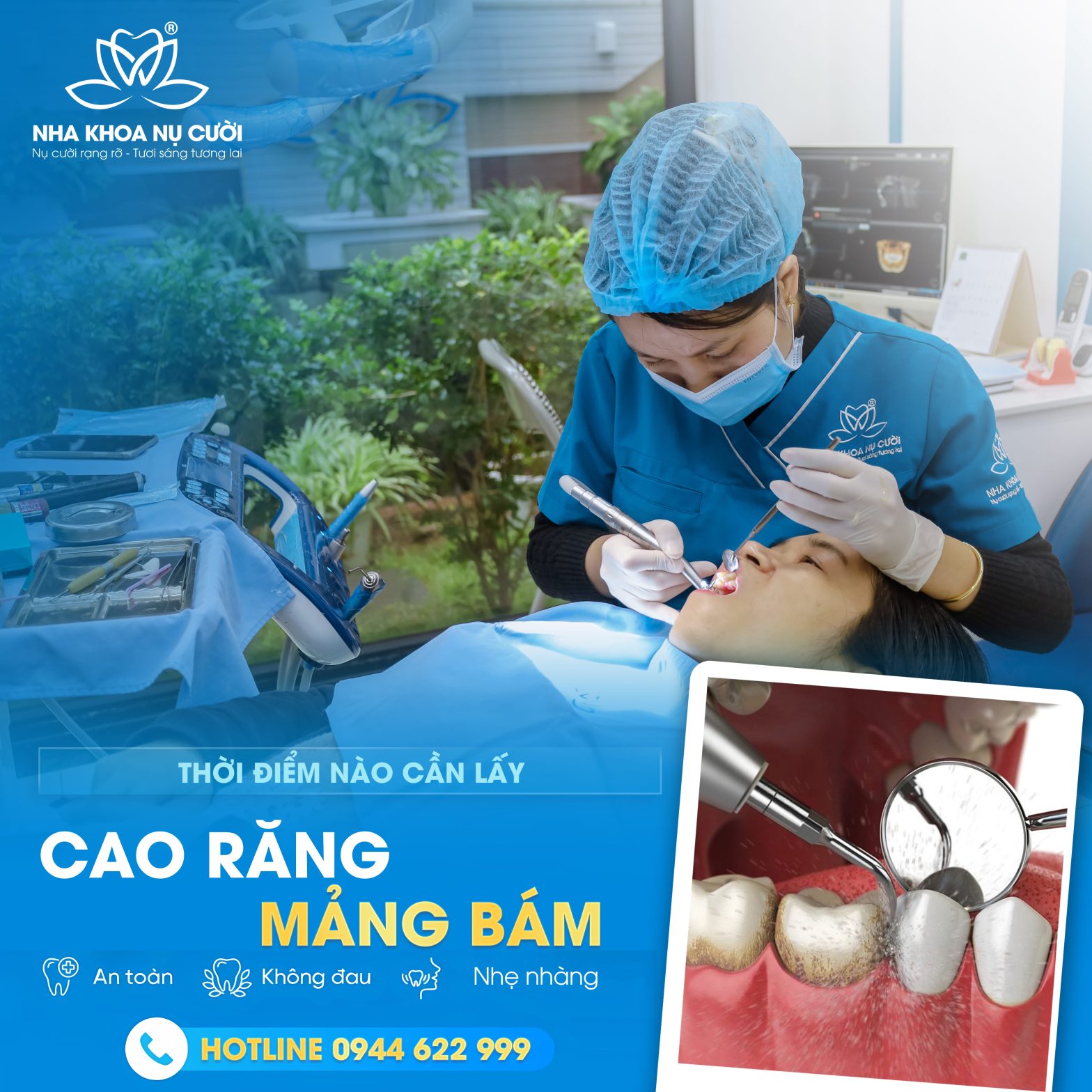 Thời Điểm Nào Cần Lấy Cao Răng Mảng Bám?