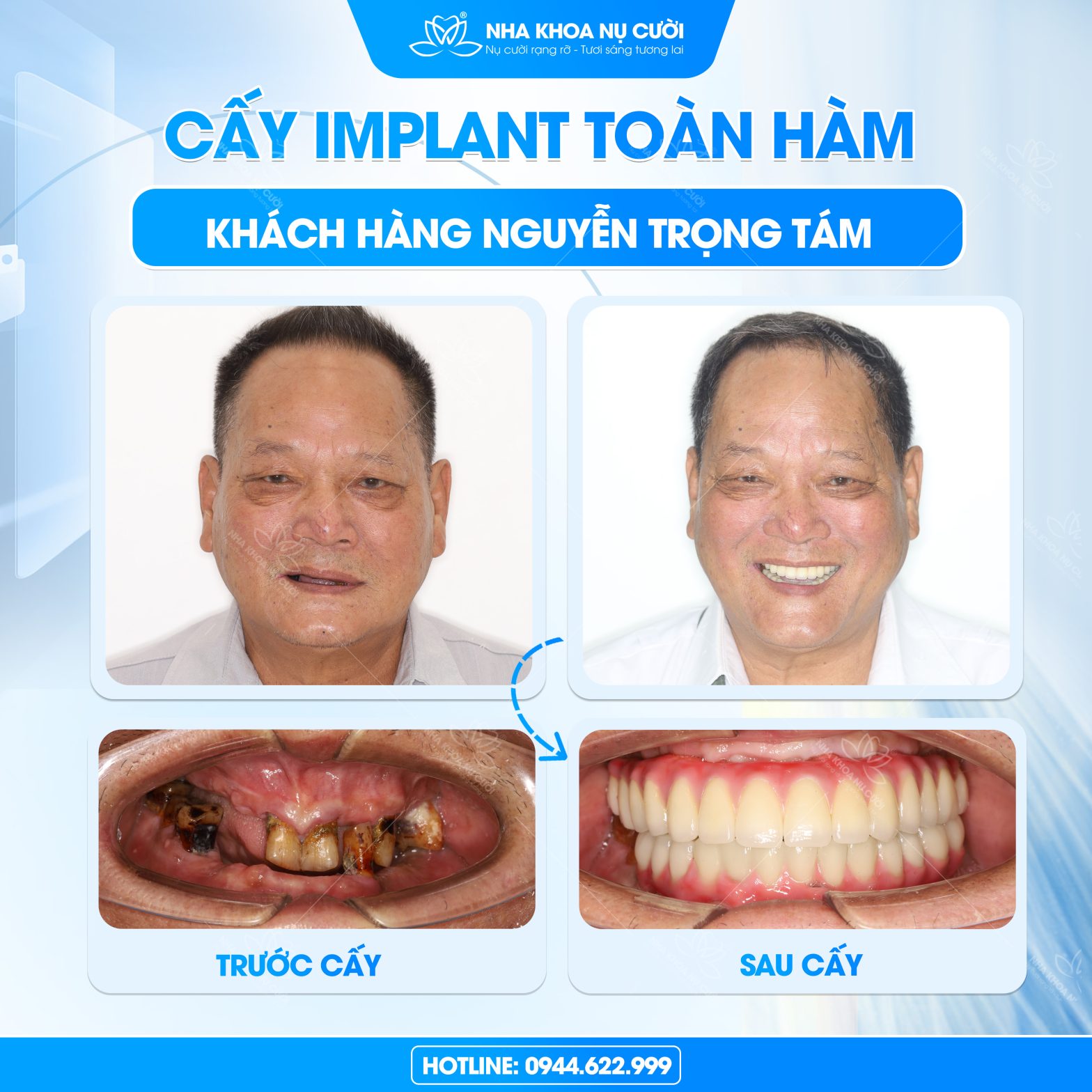 Hành trình trồng răng Implant toàn hàm cho chú Trọng Tám
