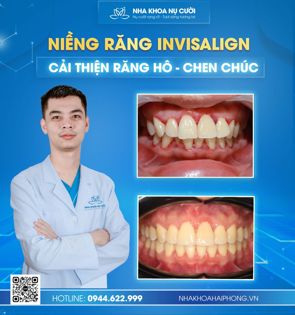 invisalign-cai-thien-ho