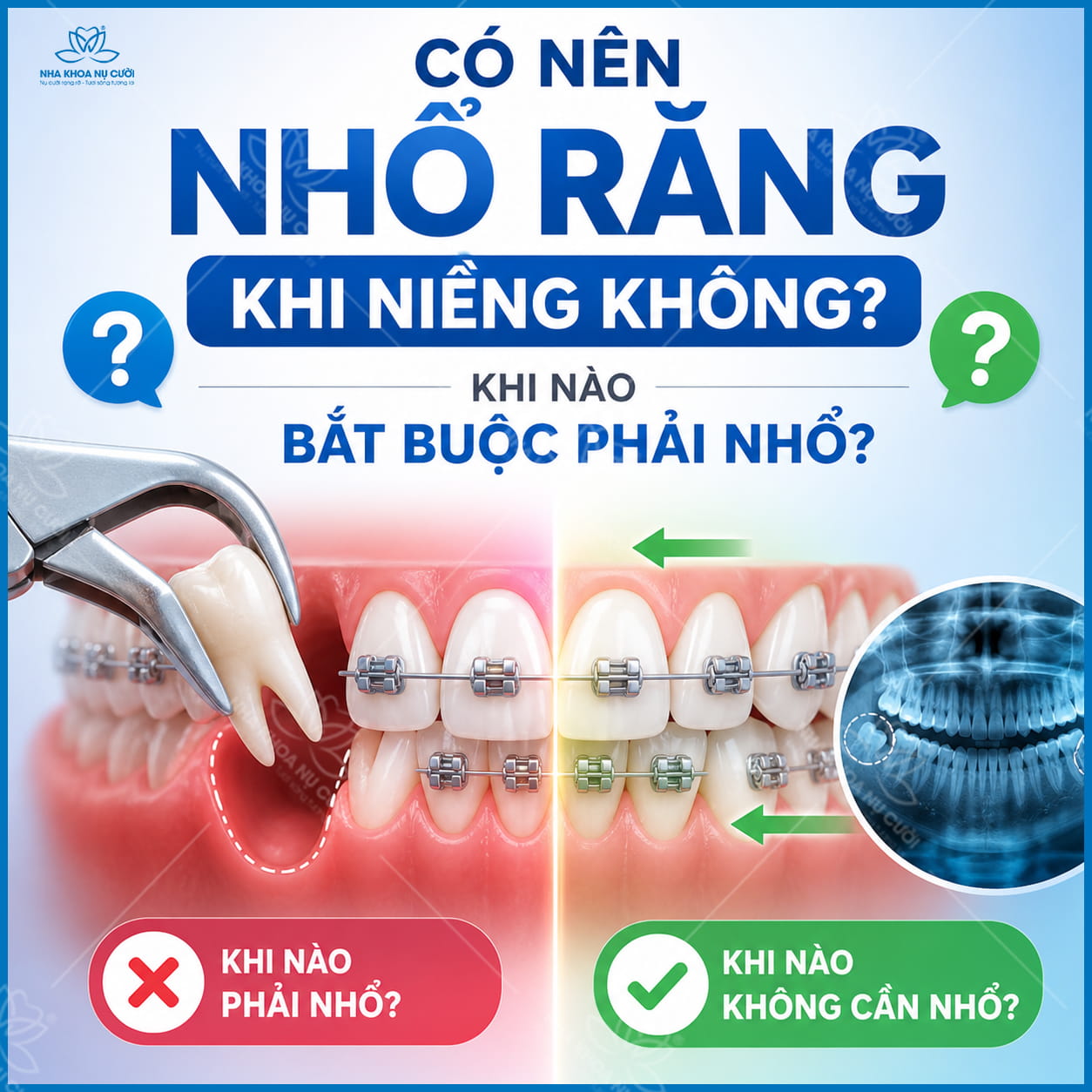 Có nên nhổ răng khi niềng không? Khi nào bắt buộc phải nhổ