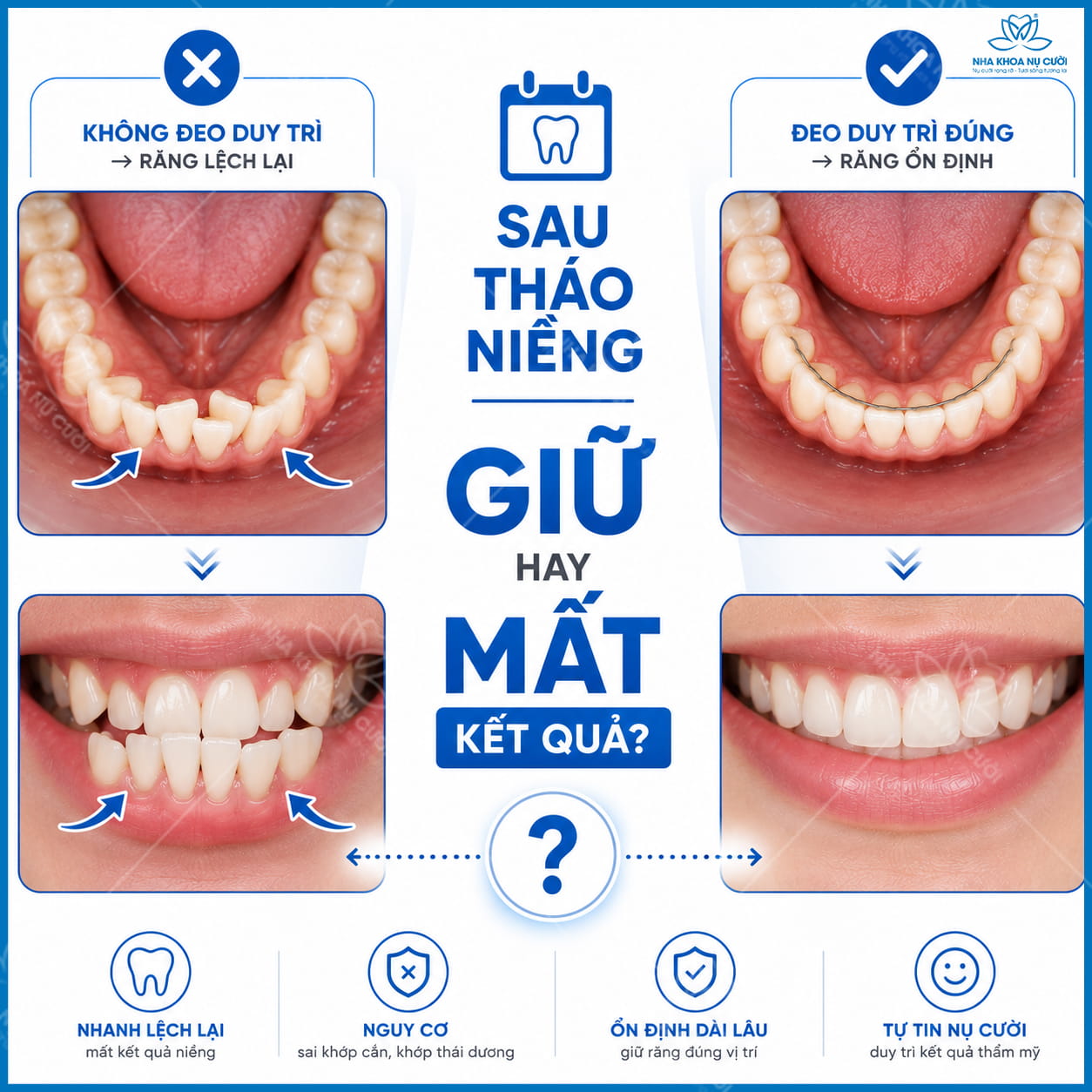 Sau tháo niềng có cần đeo hàm duy trì suốt đời không?