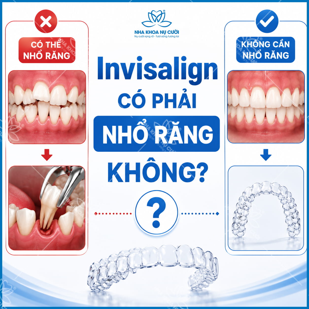 Invisalign Có Phải Nhổ Răng Không? Những Trường Hợp Cần Và Không Cần Nhổ