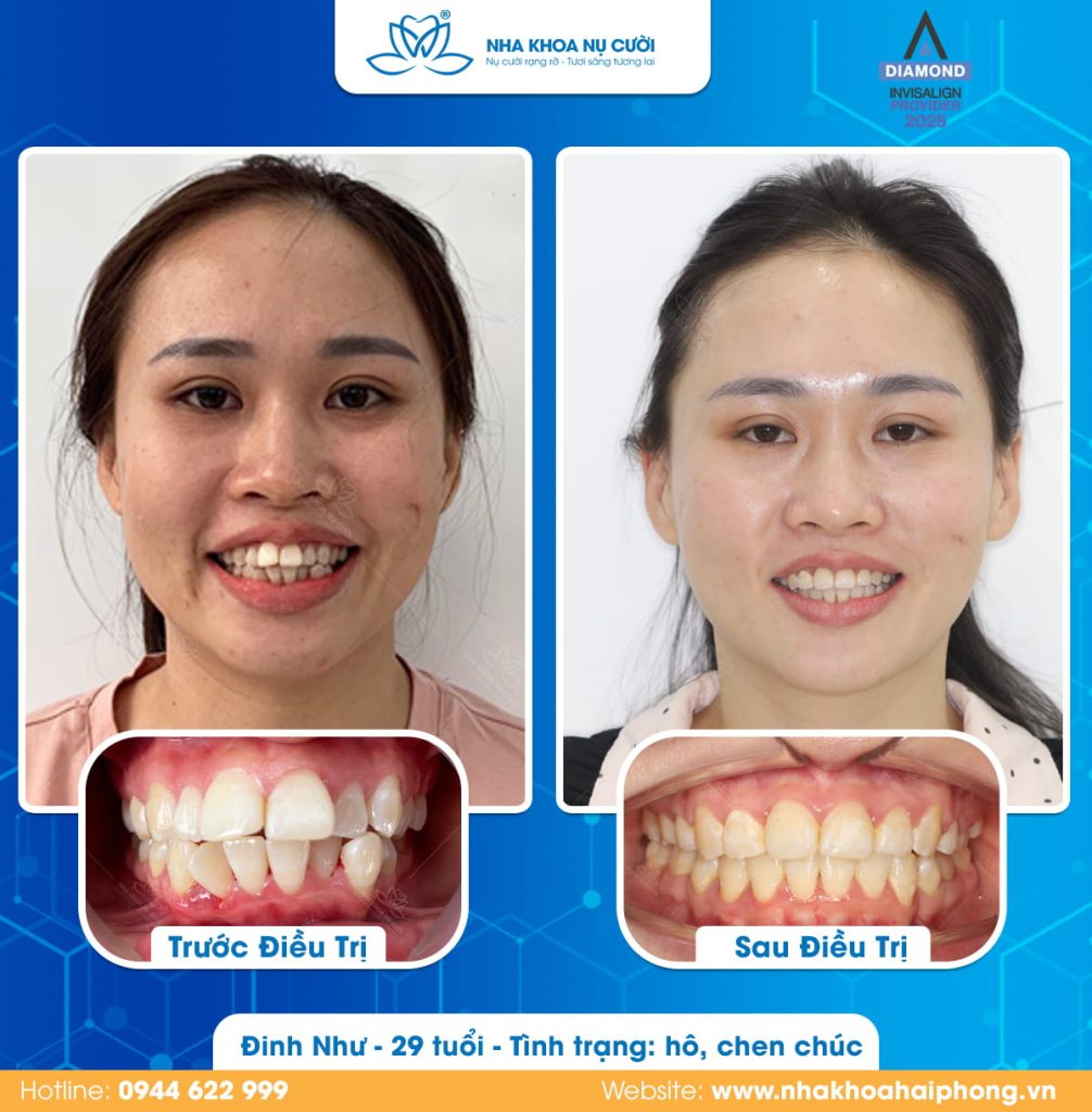 invisalign-hai-phong-cai-thien-chen-chuc-ket-hop-can-sau-