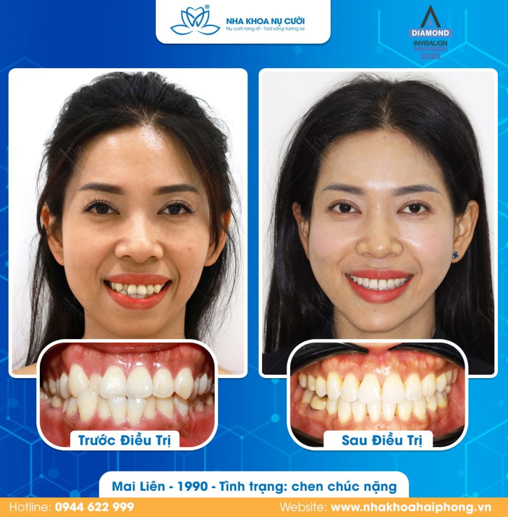 invisalign-cai-thien-chen-chuc