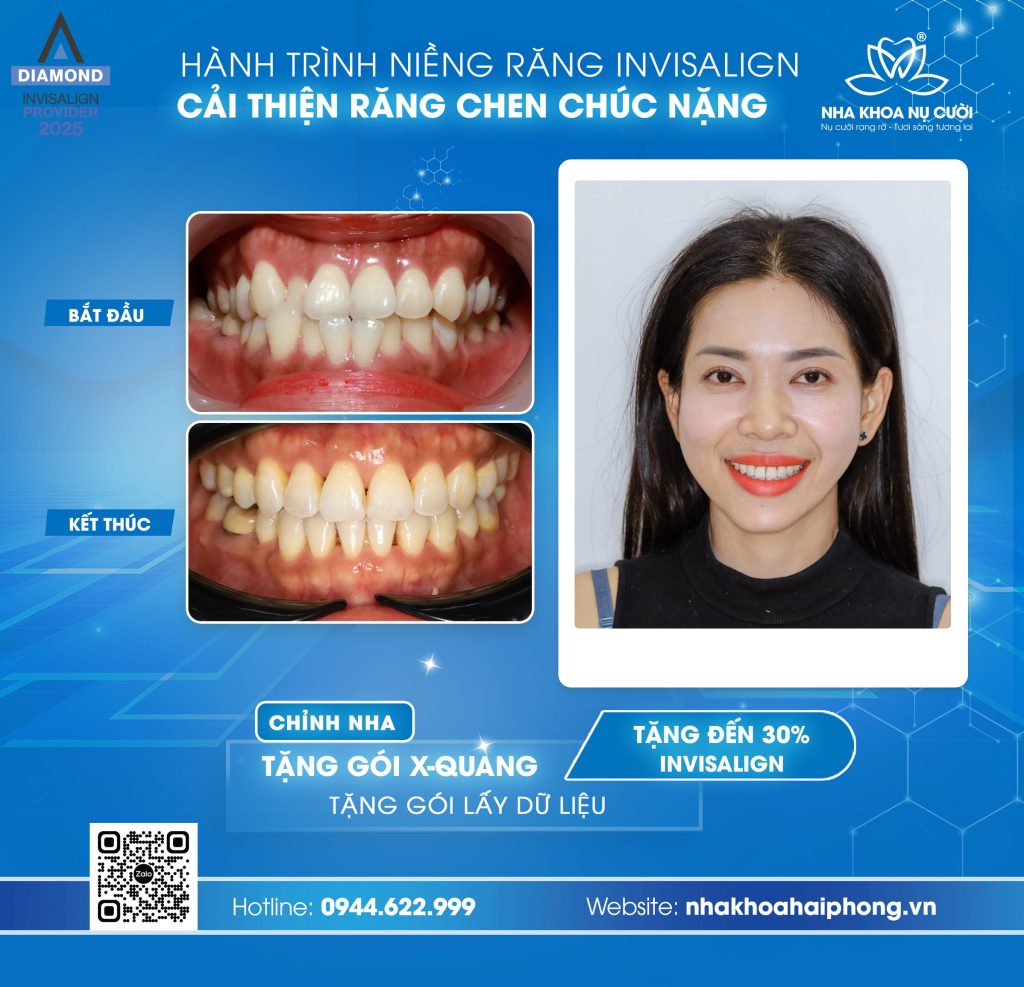 invisalign-cai-thien-chen-chuc