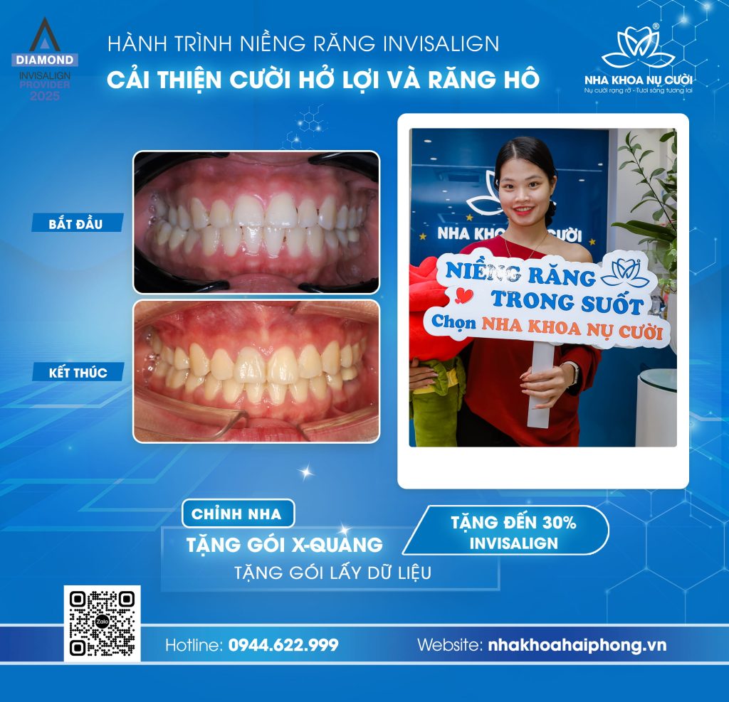 cuoi-ho-loi-rang-ho-nha-khoa-nu-cuoi-hai-phong
