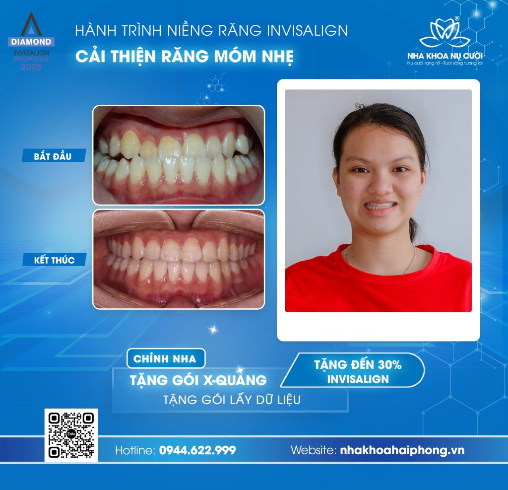 invisalign-cai-thien-mom-nhe