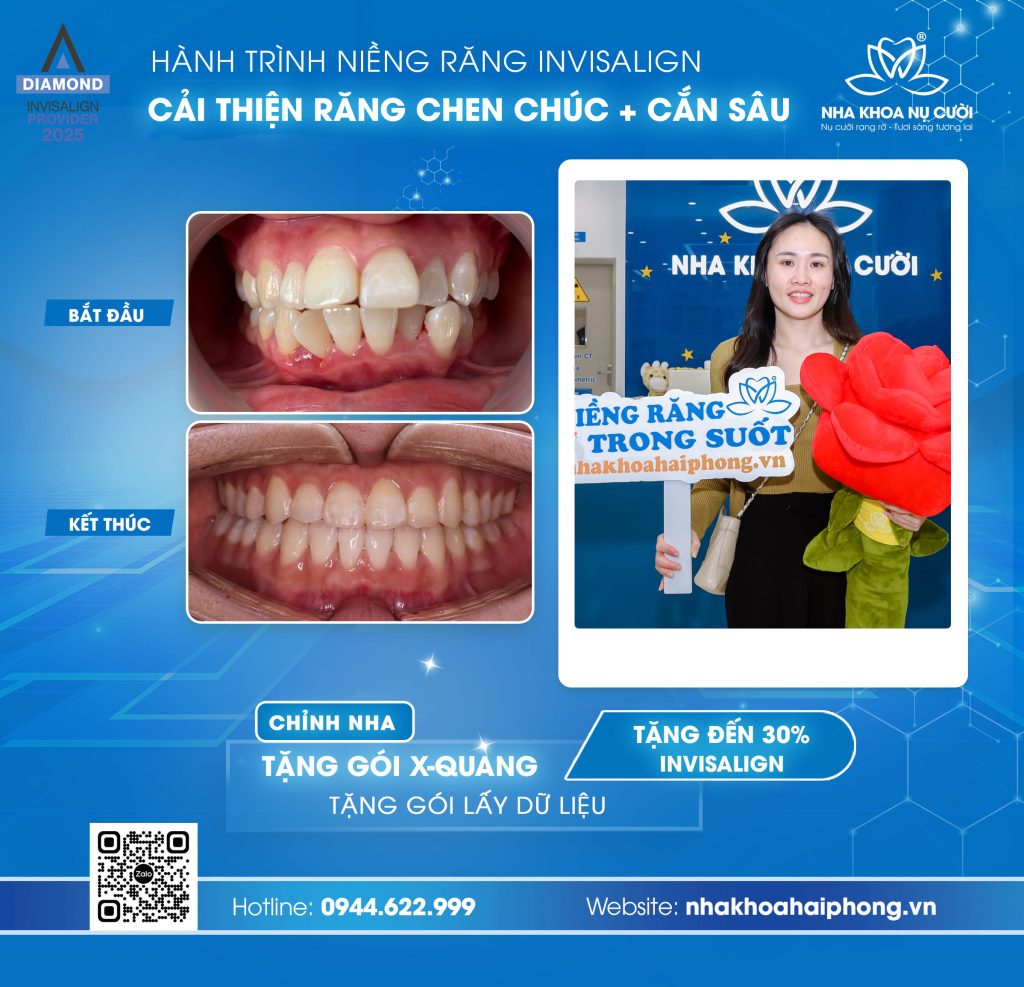 invisalign-hai-phong-cai-thien-chen-chuc-ket-hop-can-sau-