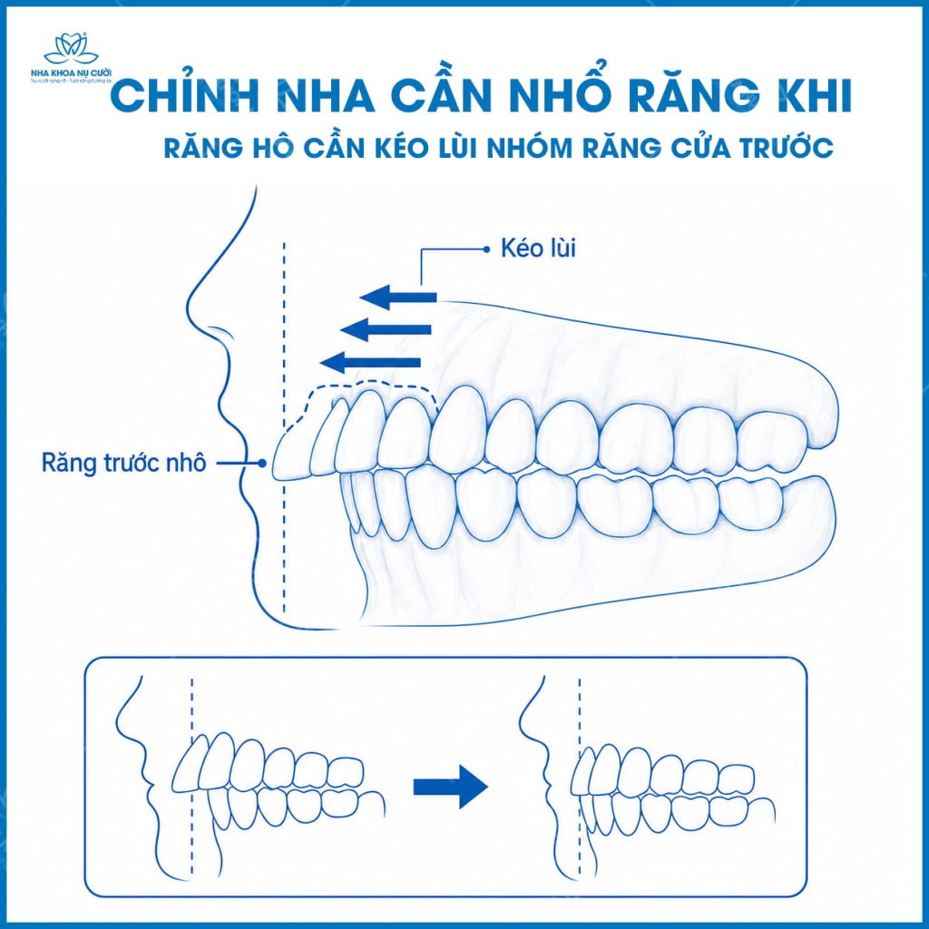 truong-hop-can-nho-rang-trong-chinh-nha
