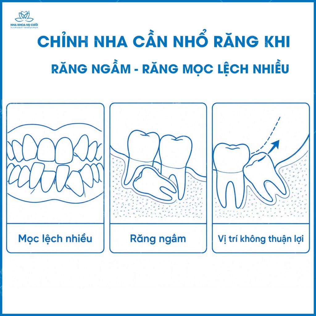 truong-hop-can-nho-rang-trong-chinh-nha