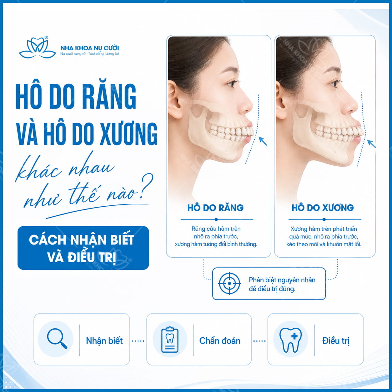 Hô do răng và hô do xương khác nhau như thế nào? Cách nhận biết và điều trị