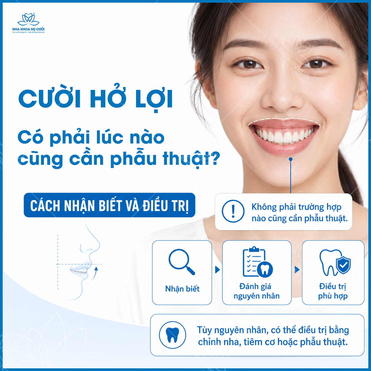 Cười hở lợi có phải lúc nào cũng cần phẫu thuật không? Cách nhận biết và điều trị