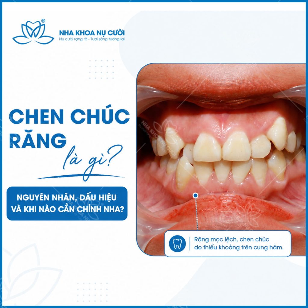chen-chuc-rang-hai-phong